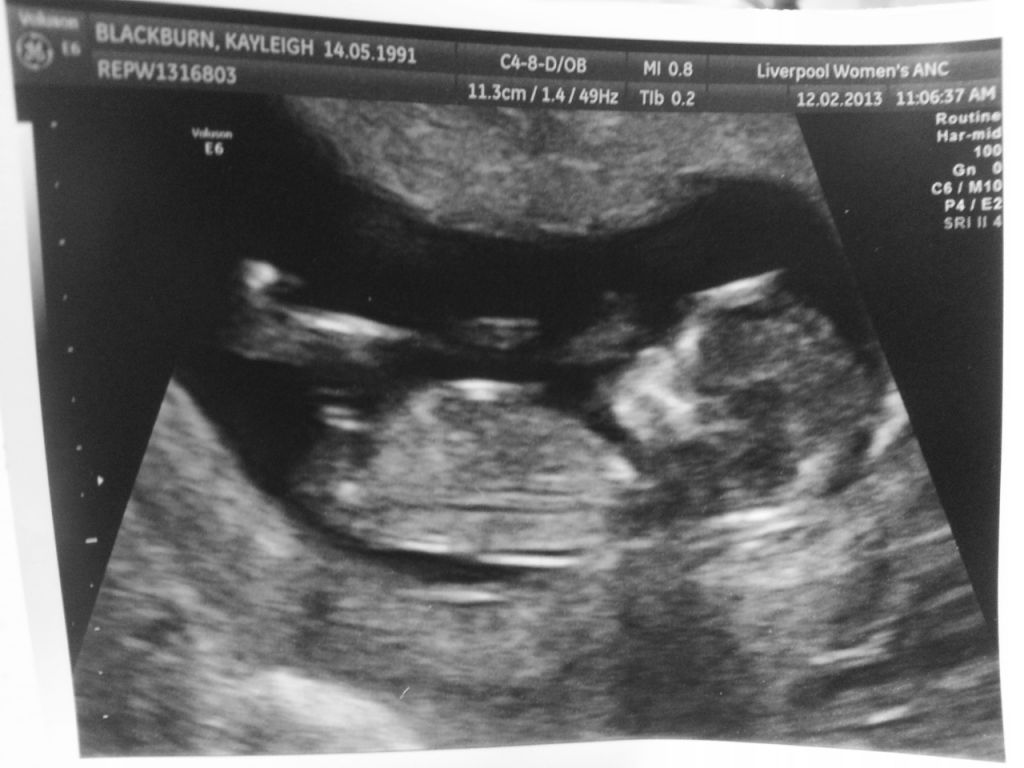 12 week scan!!! Gender guesses? BabyCentre