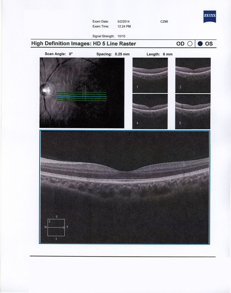 oct at tuft s medical right eye operated left eye
