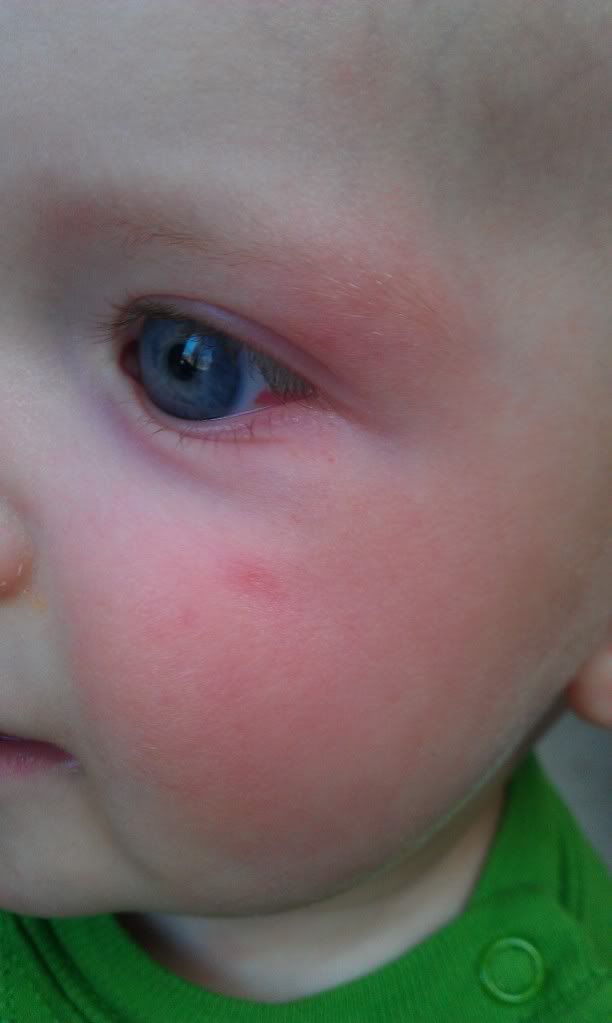 broken-blood-vessel-in-eye-pic-babycenter